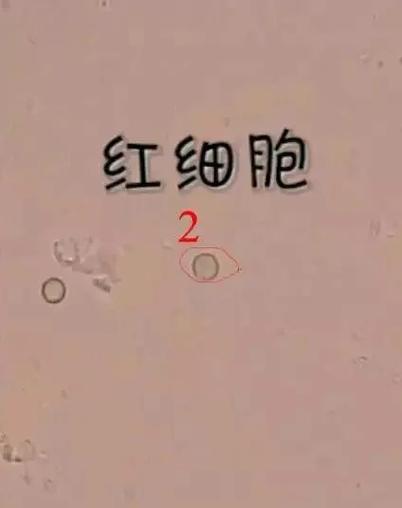 russell小体怎么读？russell小体医学？